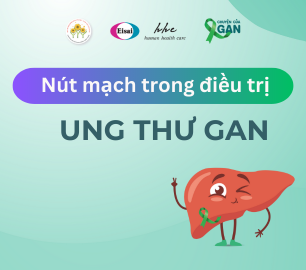 Phương pháp nút mạch ( TACE) trong điều trị ung thư gan