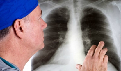 Ung thư phổi gây tử vong số 1 cho đàn ông